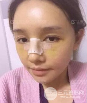 隆鼻失敗修復(fù)+詳細(xì)部自體脂肪填充案例分享，上海華美做的!