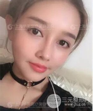 隆鼻失敗修復(fù)+詳細(xì)部自體脂肪填充案例分享，上海華美做的!