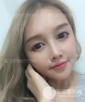 隆鼻失敗修復(fù)+詳細(xì)部自體脂肪填充案例分享，上海華美做的!