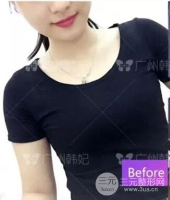 廣州韓妃劉志剛自體脂肪豐胸案例前后對比圖分享~