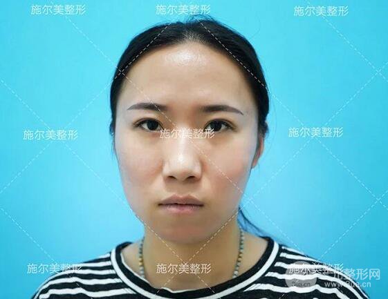 南京施爾美玻尿酸注射案例,讓蘋果肌嘭嘭嘭！