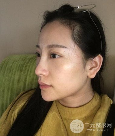 內(nèi)切微創(chuàng)去眼袋手術(shù)案例分享，附上手術(shù)恢復(fù)照片
