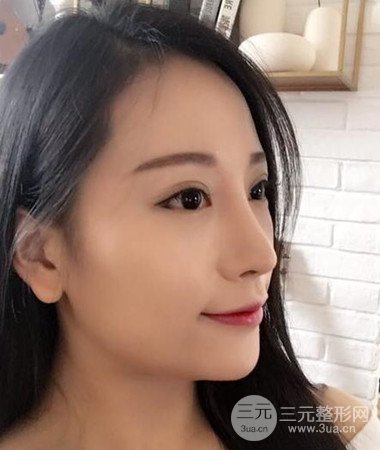 內(nèi)切微創(chuàng)去眼袋手術(shù)案例分享，附上手術(shù)恢復(fù)照片