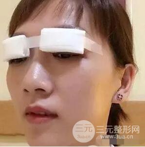 吉林銘醫(yī)李紅雙眼皮修復前后對比圖 內附吉林銘醫(yī)小彩蛋哦