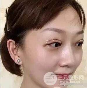 吉林銘醫(yī)李紅雙眼皮修復前后對比圖 內附吉林銘醫(yī)小彩蛋哦