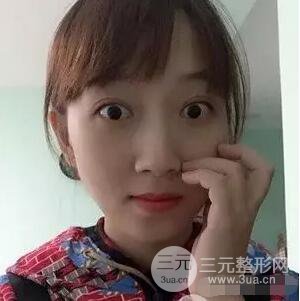 吉林銘醫(yī)李紅雙眼皮修復前后對比圖 內附吉林銘醫(yī)小彩蛋哦
