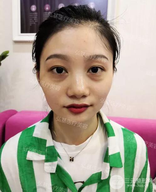 廣州弘基醫(yī)療美容祛眼袋案例,看看她是怎么變美的！
