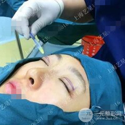 上海藝星雙眼皮日記分享，割雙眼皮后大變樣！