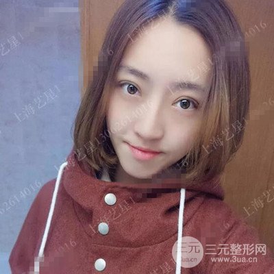 上海藝星雙眼皮日記分享，割雙眼皮后大變樣！