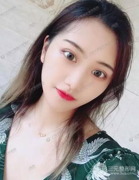 上海華美楊亞益全切雙眼皮案例對比圖 男女雙眼皮案例混搭