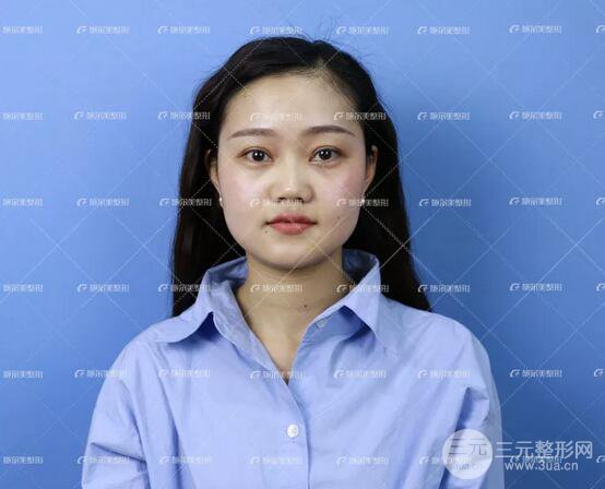 南京施爾美整形孫欣線D案例,重返17歲！
