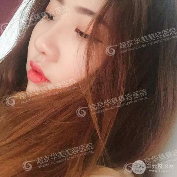 南京華美膨體隆鼻+耳軟骨墊鼻尖+鼻中隔矯正案例前后對比圖分享~