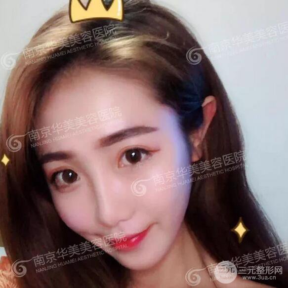 南京華美膨體隆鼻+耳軟骨墊鼻尖+鼻中隔矯正案例前后對比圖分享~