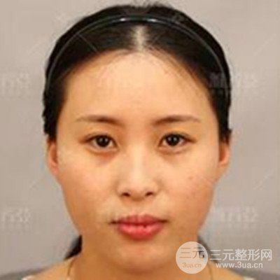 石家莊雅芳亞注射玻尿酸豐太陽(yáng)穴+下巴+隆鼻案例分享~
