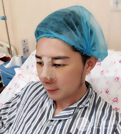 肋軟骨隆鼻整形案例分享，在深圳雅涵做的!