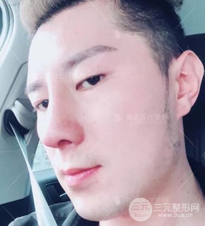 肋軟骨隆鼻整形案例分享，在深圳雅涵做的!