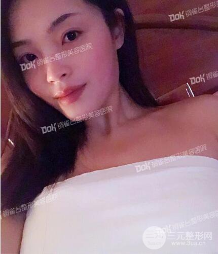 重慶銅雀臺假體隆胸案例恢復果圖