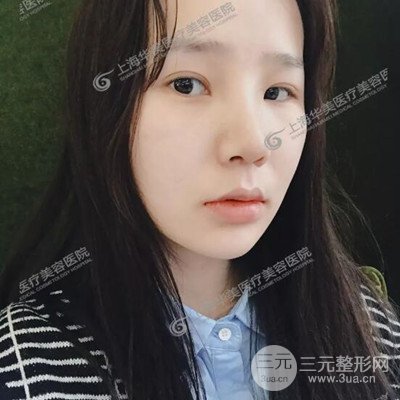 上海華美李志海隆鼻整形案例前后對(duì)比圖分享~