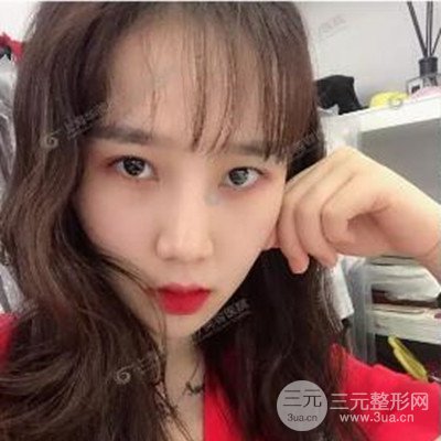 上海華美李志海隆鼻整形案例前后對(duì)比圖分享~