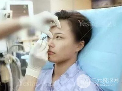 成都藝星切開(kāi)雙眼皮+隆鼻整形日記分享