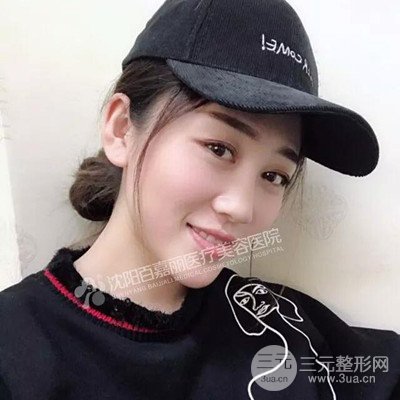 沈陽(yáng)百嘉麗隆鼻整形前后恢復(fù)圖記錄分享~