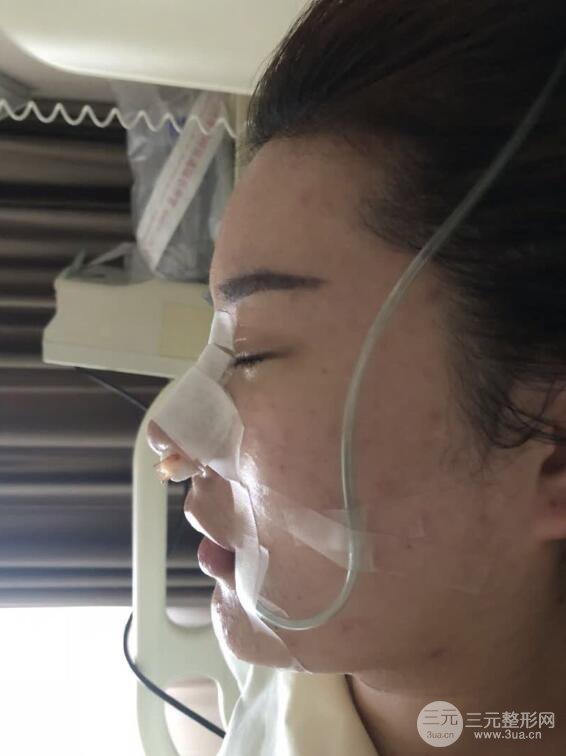 上海華美李庭勛假體隆鼻前后對比圖一個月恢復(fù)心情日記