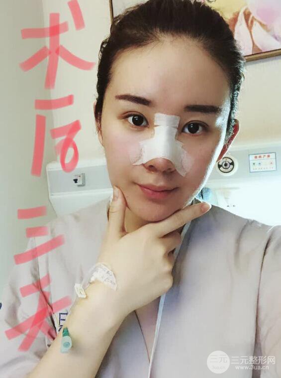 上海華美李庭勛假體隆鼻前后對比圖一個月恢復心情日記