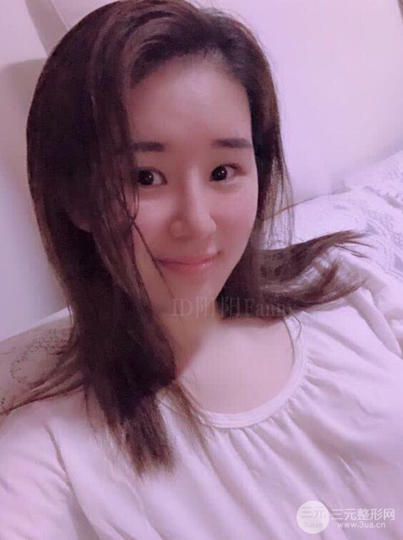 上海華美李庭勛假體隆鼻前后對比圖一個月恢復心情日記
