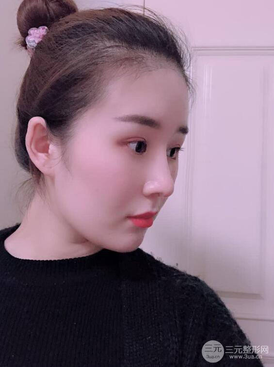 上海華美李庭勛假體隆鼻前后對比圖一個月恢復心情日記