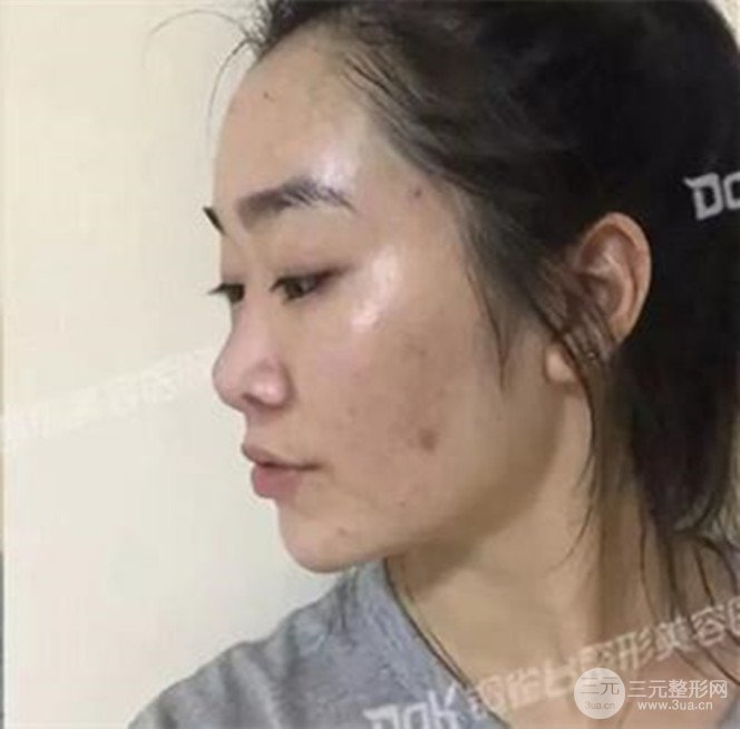 重慶銅雀臺假體隆鼻前后對比圖案例分享!