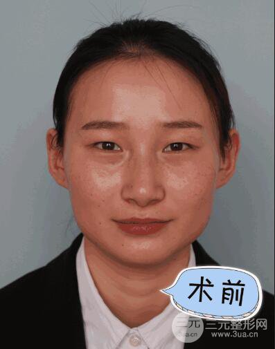 濟(jì)南瑞麗水光補(bǔ)水注射案例果圖真人秀