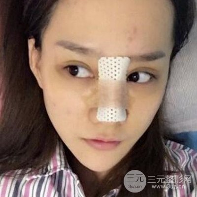 廣州韓妃李光琴隆鼻失敗修復前后對比圖分享！