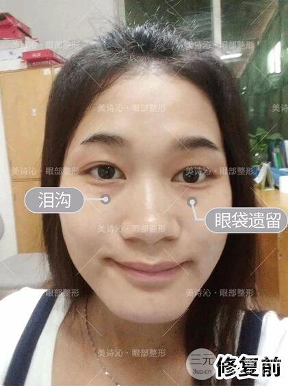 北京詩美沁祛眼袋案例術(shù)后果分享！