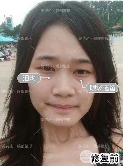 北京詩美沁祛眼袋案例術后果分享！