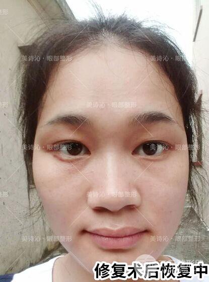 北京詩美沁祛眼袋案例術后果分享！