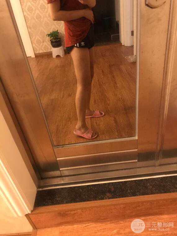 德陽東美奧克拉楊華博大腿吸脂前后對比圖 四個月恢復(fù)變化小記