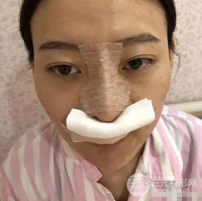 南京華美隆鼻整形前后對比圖分享