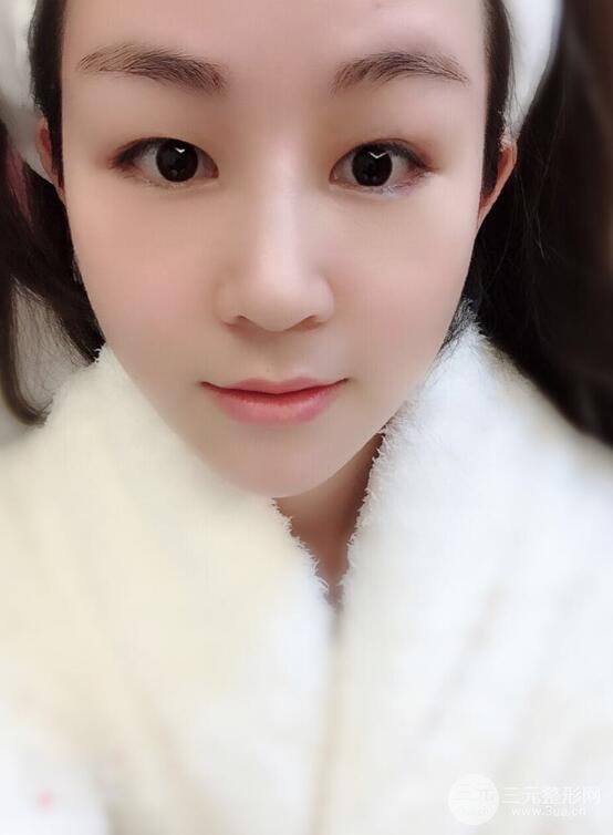 杭州華山連天美高俊明假體隆鼻術前術后對比圖 兩個月恢復心情
