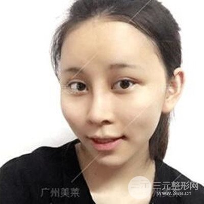 廣州美萊隆鼻整形+自體脂肪填充面部前后對比圖以及恢復(fù)過程分享