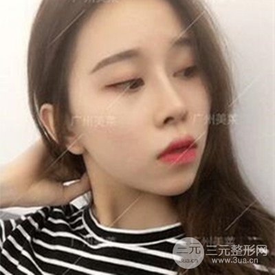 廣州美萊隆鼻整形+自體脂肪填充面部前后對比圖以及恢復(fù)過程分享