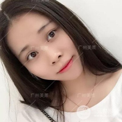 廣州美萊隆鼻整形+自體脂肪填充面部前后對比圖以及恢復(fù)過程分享