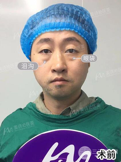 北京詩美沁祛眼袋案例，男士微創(chuàng)祛眼袋果分享！