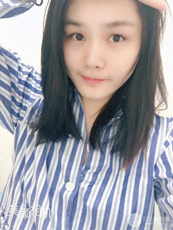 蘇州紫馨顧陸健韓式隆鼻前后對比圖|真人案例心情日記