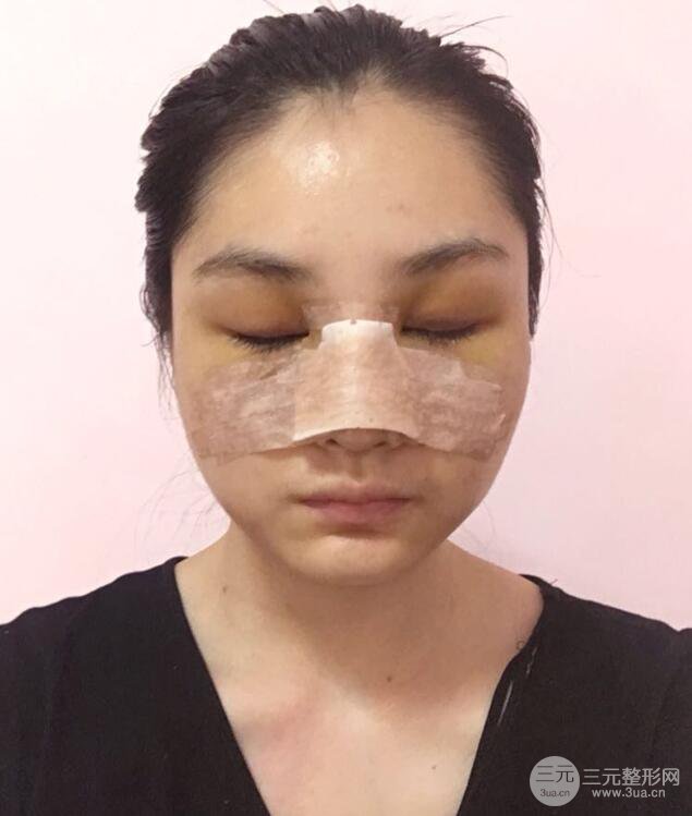 蘇州紫馨顧陸健韓式隆鼻前后對(duì)比圖|真人案例心情日記