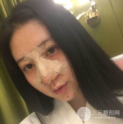 合肥壹加壹假體隆鼻果對比圖 45天恢復(fù)心路歷程