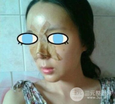 杭州華山連天美膨體隆鼻日記前后對(duì)比圖分享~