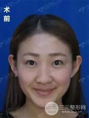 沈陽(yáng)杏林史靈芝醫(yī)生隆鼻整形案例日記分享~
