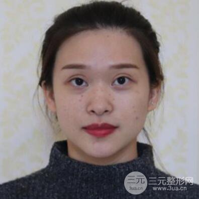 哈美萊鄭東學(xué)隆鼻整形案例對(duì)比圖真實(shí)心情分享喲~