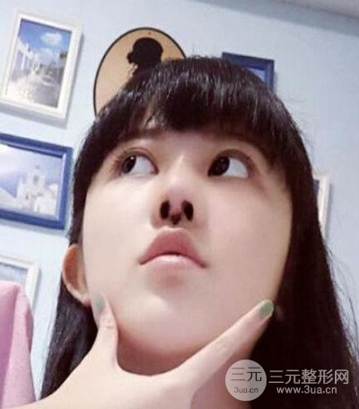 濟(jì)南韓氏郭廣科醫(yī)生隆鼻案例分享~