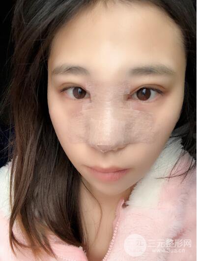貴陽(yáng)麗都李觀(guān)龍隆鼻整形案例對(duì)照?qǐng)D一個(gè)月恢復(fù)過(guò)程分享